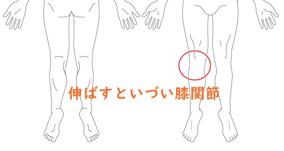 伸ばすと痛い膝関節