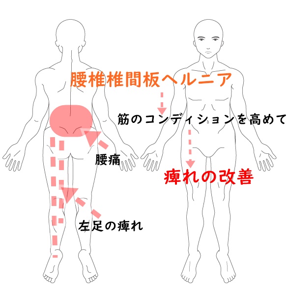 腰椎椎間板ヘルニア