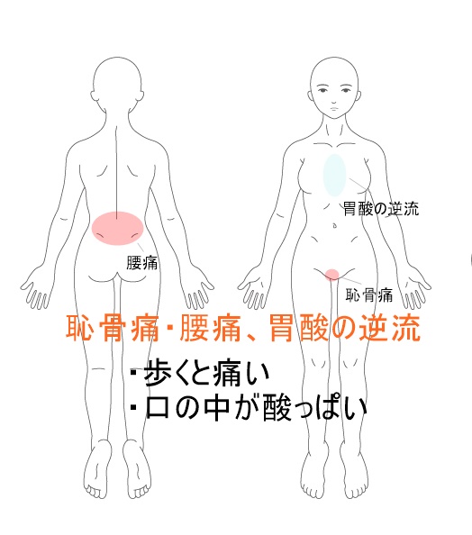 恥骨の痛みと胃酸の逆流