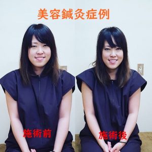 美容鍼灸